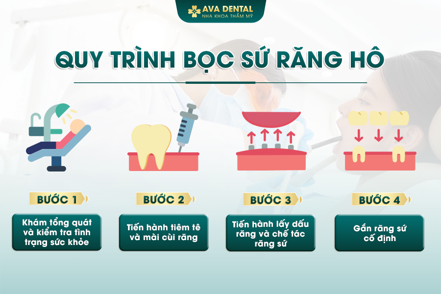 Bọc Răng Sứ Cho Răng Hô Là Gì? Chi Phí Bao Nhiêu 2024 23 quy trinh boc su rang ho