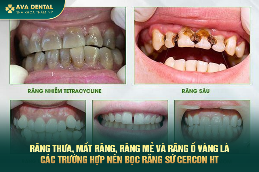 Răng Sứ Cercon HT Là Gì? Có Tốt Không? Chi Phí Bao Nhiêu 2024 18 rang su cercon ht 3