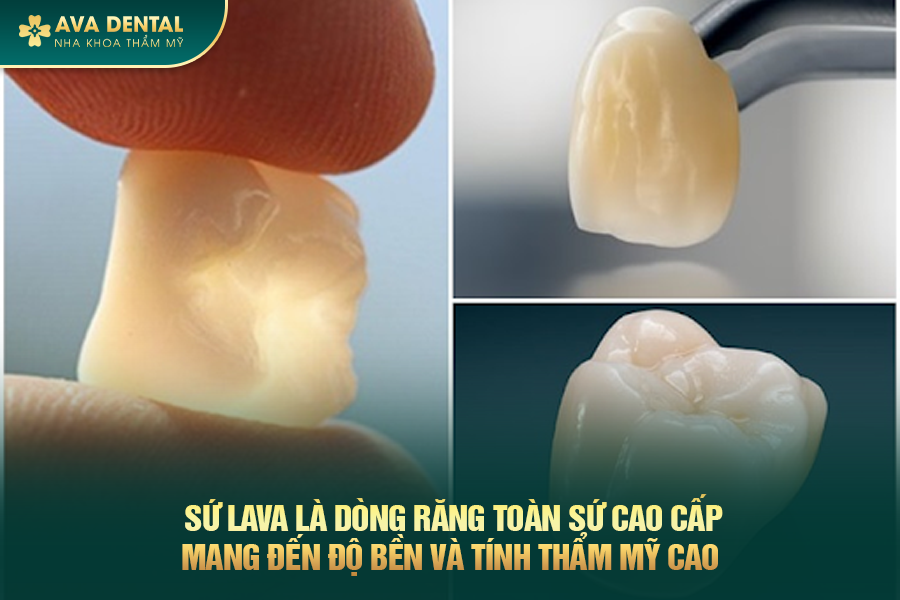 Răng Sứ Lava Là Gì? Phân Loại Và Bảng Giá Mới Nhất 2025 17 rang su lava 2 1