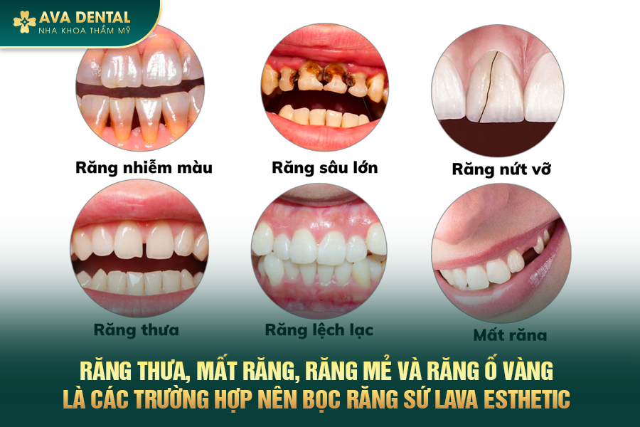 Răng Sứ Lava Esthetic Là Gì? Có Tốt Không? Chi Phí Bao Nhiêu 2024 22 rang su lava esthetic 3