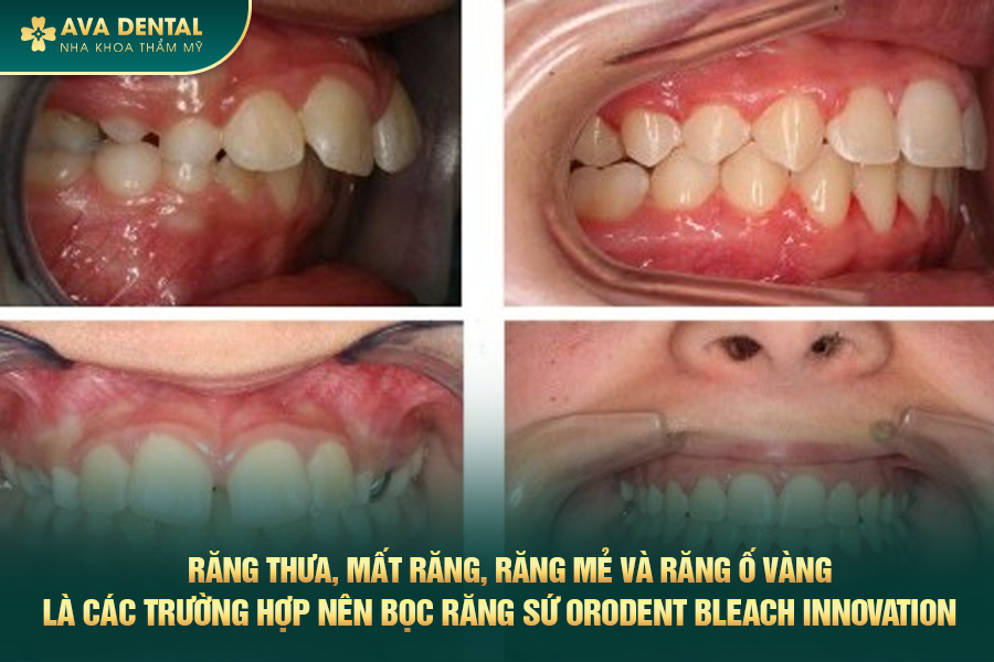 Răng Sứ Orodent Bleach Innovation Là Gì? Có Tốt Không? Chi Phí Bao Nhiêu 2024 22 rang su orodent bleach innovation 4