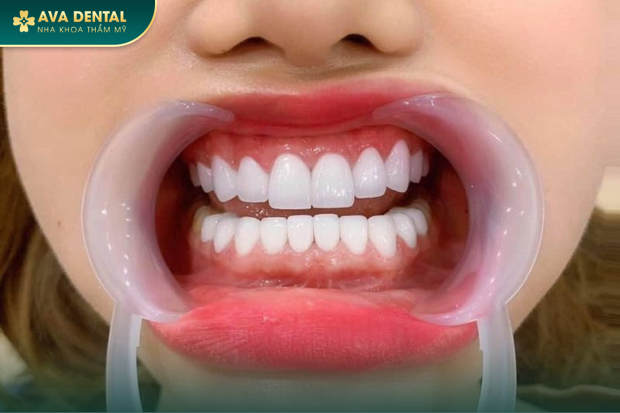 Răng Sứ Zirconia Là Gì? Có Mấy Loại? Bảng Giá Mới Nhất 2024 24 1 10