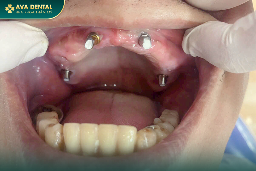 Trụ Implant Straumann Thụy Sỹ: Xuất Xứ, Ưu Điểm Và Chi Phí 2024? 22 1 19