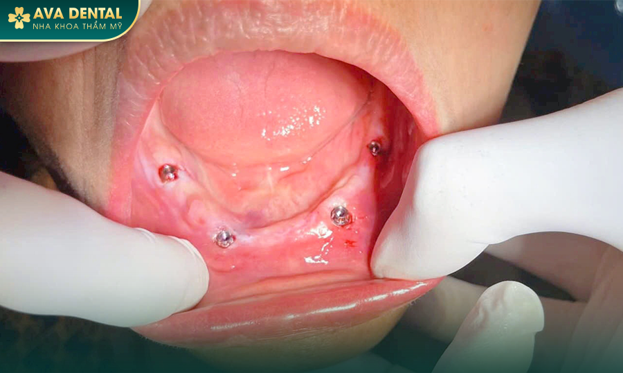 Trồng Răng Implant All On 4 Cho Người Mất Răng Toàn Hàm? Chi Phí Bao Nhiêu 2024? 17 1 21