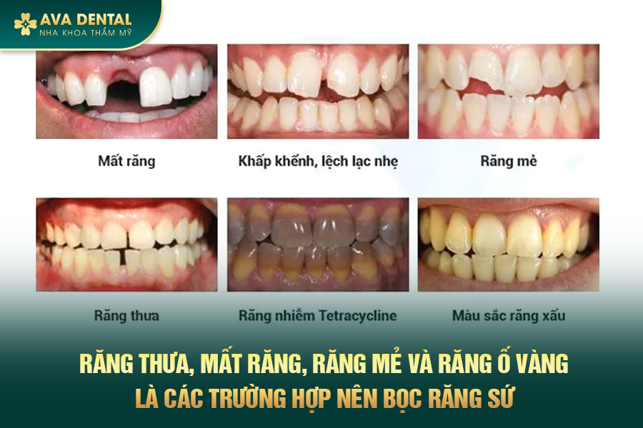 Chi Phí Bọc Răng Sứ Thẩm Mỹ Bao Nhiêu? Bảng Giá Mới Nhất 2024 22 1 7