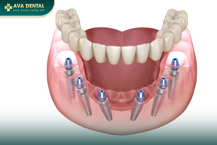 Trồng Răng Implant All On 6 Cho Người Mất Răng Toàn Hàm? Chi Phí Bao Nhiêu 2024? 13 100 1
