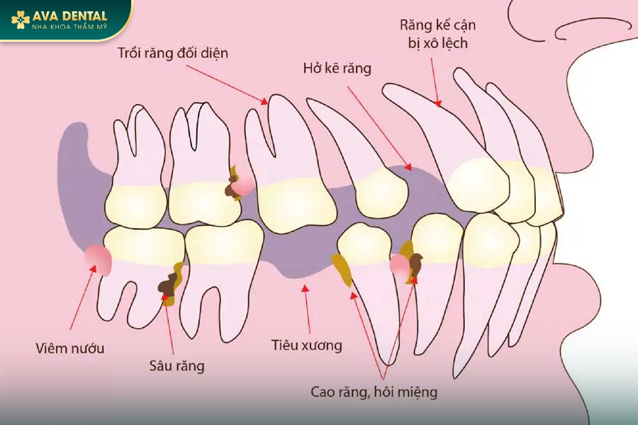 Trồng Implant 1 Răng Là Gì? Giá Bao Nhiêu 2024? 19 100 10