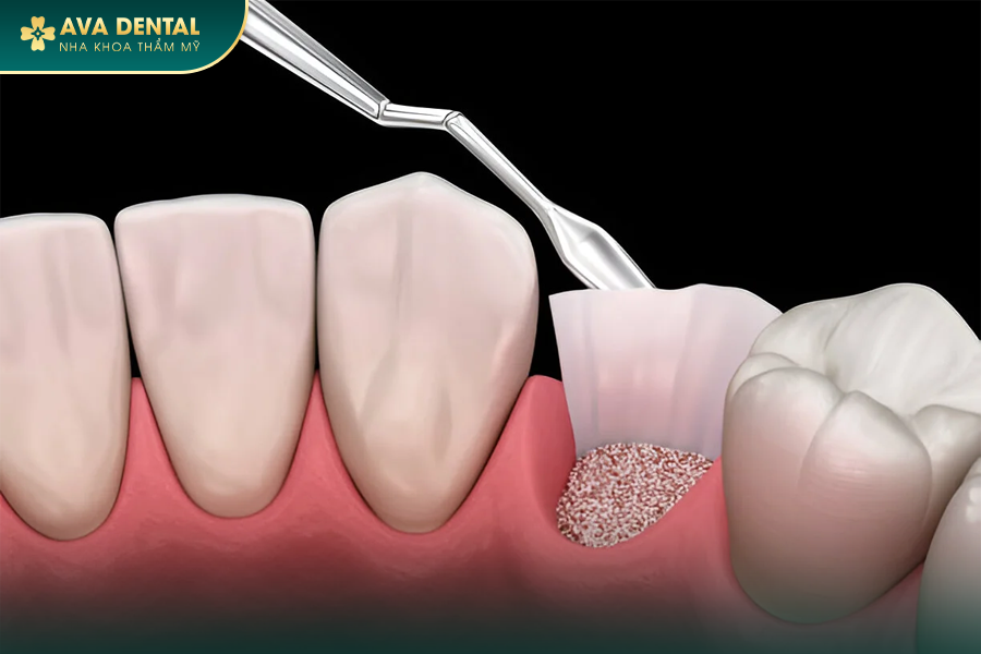 Ghép Xương Răng Trong Cấy Ghép Implant Là Gì? Chi Phí Bao Nhiêu 2024? 12 100 2
