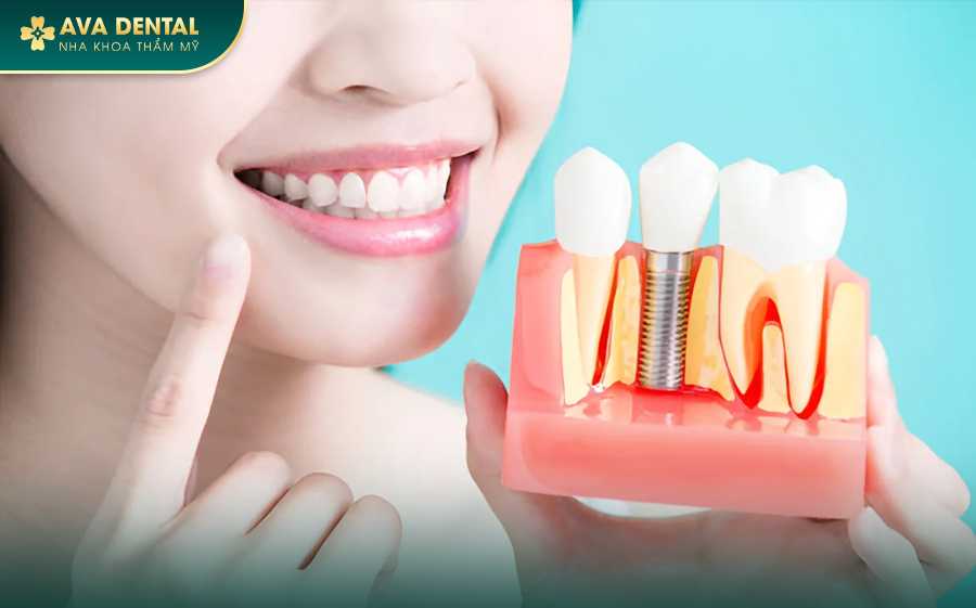 Trồng Răng Implant Trả Góp 0% Lãi Suất Tại Nha Khoa Avora Dental 16 100 5