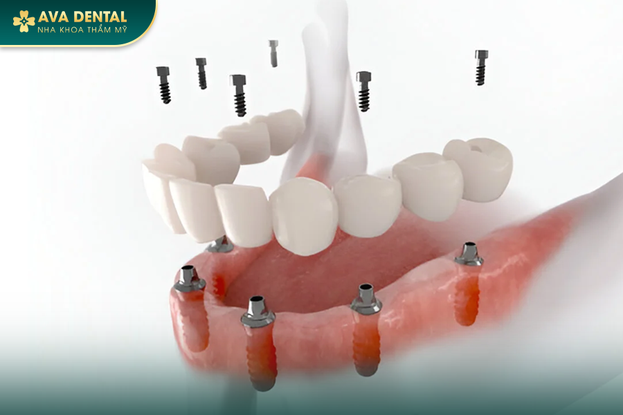 Trồng Răng Implant All On 6 Cho Người Mất Răng Toàn Hàm? Chi Phí Bao Nhiêu 2024? 14 101 1