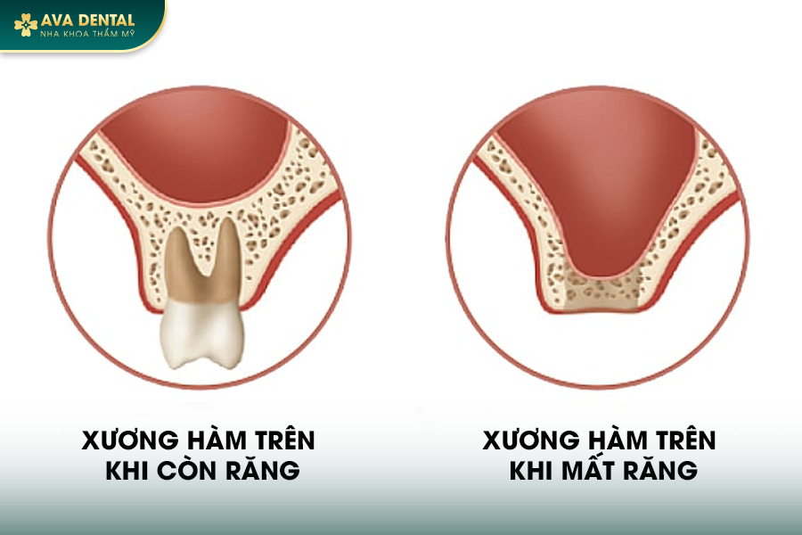 Trồng Implant 1 Răng Là Gì? Giá Bao Nhiêu 2024? 20 101 8