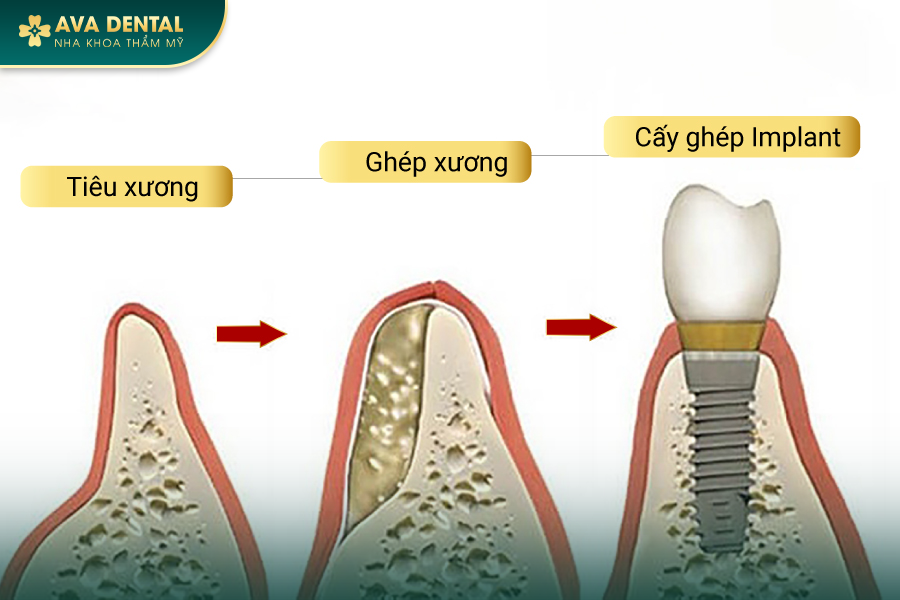 Ghép Xương Răng Trong Cấy Ghép Implant Là Gì? Chi Phí Bao Nhiêu 2024? 15 102 1