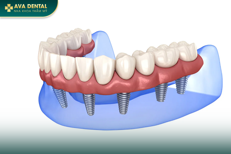 Trồng Răng Implant All On 6 Cho Người Mất Răng Toàn Hàm? Chi Phí Bao Nhiêu 2024? 17 102