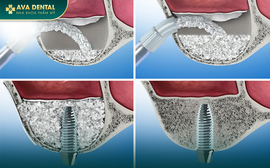 Ghép Xương Răng Trong Cấy Ghép Implant Là Gì? Chi Phí Bao Nhiêu 2024? 19 104 1