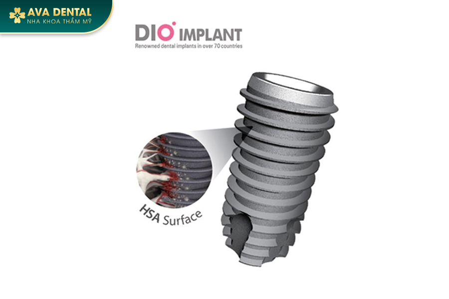 Top 10 Dòng Trụ Implant Hàn Quốc Chất Lượng Tốt Nhất Hiện Nay 34 104 2