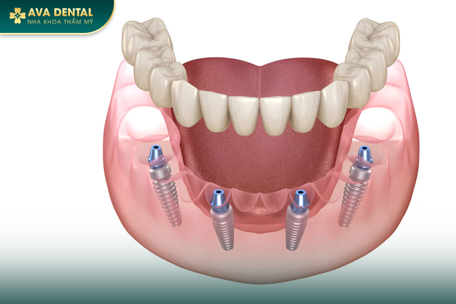Trồng Răng Implant All On 4 Cho Người Mất Răng Toàn Hàm? Chi Phí Bao Nhiêu 2024? 13 104