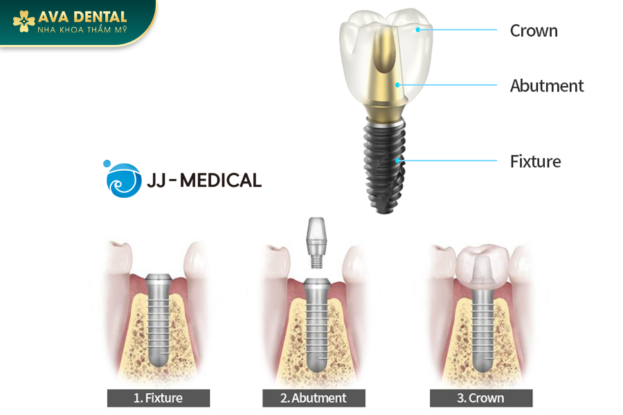 Top 10 Dòng Trụ Implant Hàn Quốc Chất Lượng Tốt Nhất Hiện Nay 31 105 1