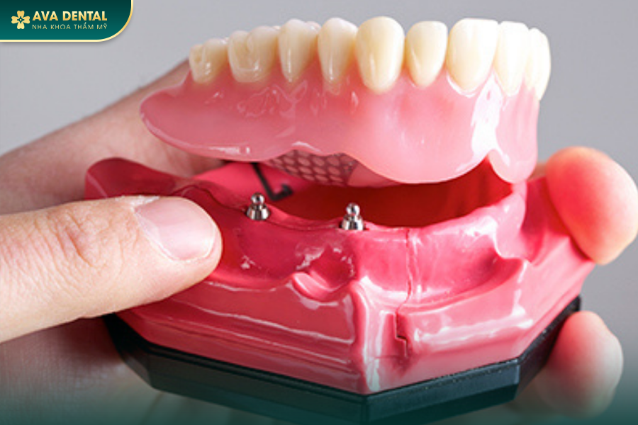 Hàm Tháo Lắp Trên Implant: Giải Pháp Trồng Răng Giả Tiết Kiệm 2024 12 182 4