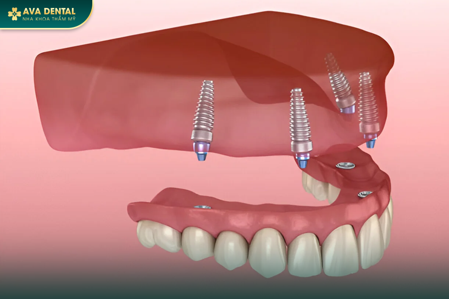 Hàm Tháo Lắp Trên Implant: Giải Pháp Trồng Răng Giả Tiết Kiệm 2024 13 183 4