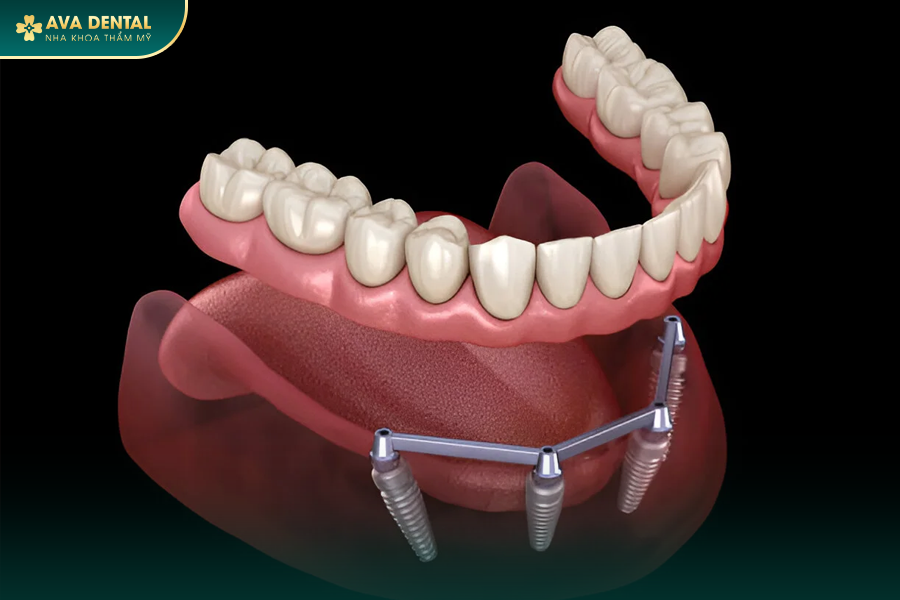 Hàm Tháo Lắp Trên Implant: Giải Pháp Trồng Răng Giả Tiết Kiệm 2024 15 184 1