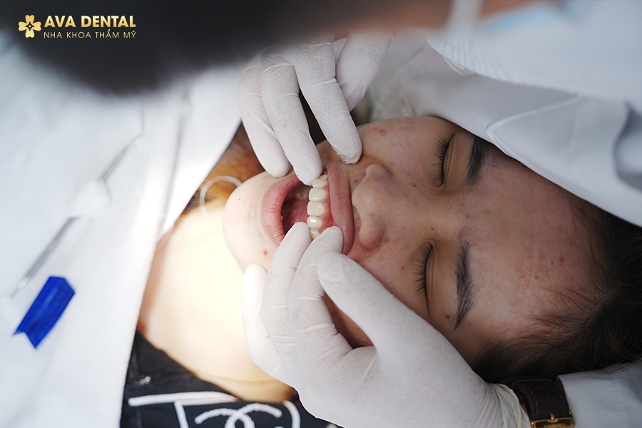 Chi Phí Bọc Răng Sứ Thẩm Mỹ Bao Nhiêu? Bảng Giá Mới Nhất 2024 26 2 12