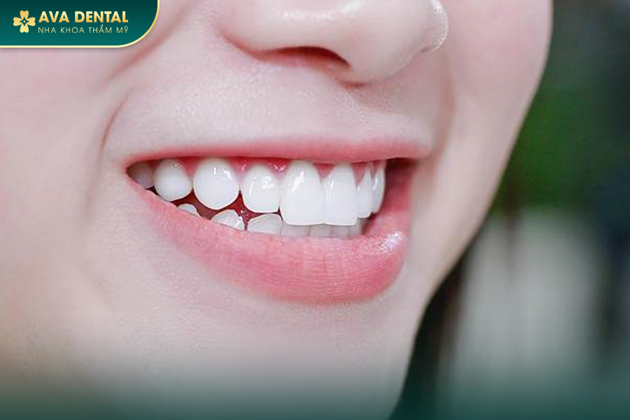 Dán Sứ Veneer Răng Thỏ Là Gì? Chi Phí Bao Nhiêu 2024 17 2 6