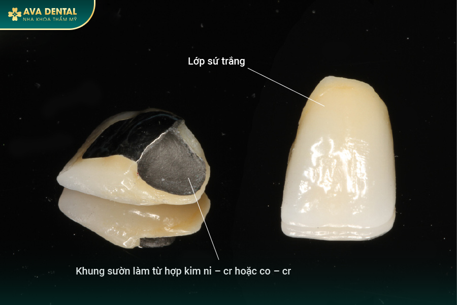 Bọc Răng Sứ Kim Loại Là Gì? Có Tốt Không? Chi Phí Bao Nhiêu 2024? 15 2 8