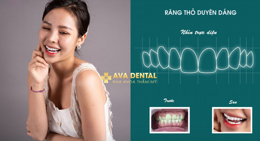 Dán Sứ Veneer Răng Thỏ Là Gì? Chi Phí Bao Nhiêu 2024 19 3 6