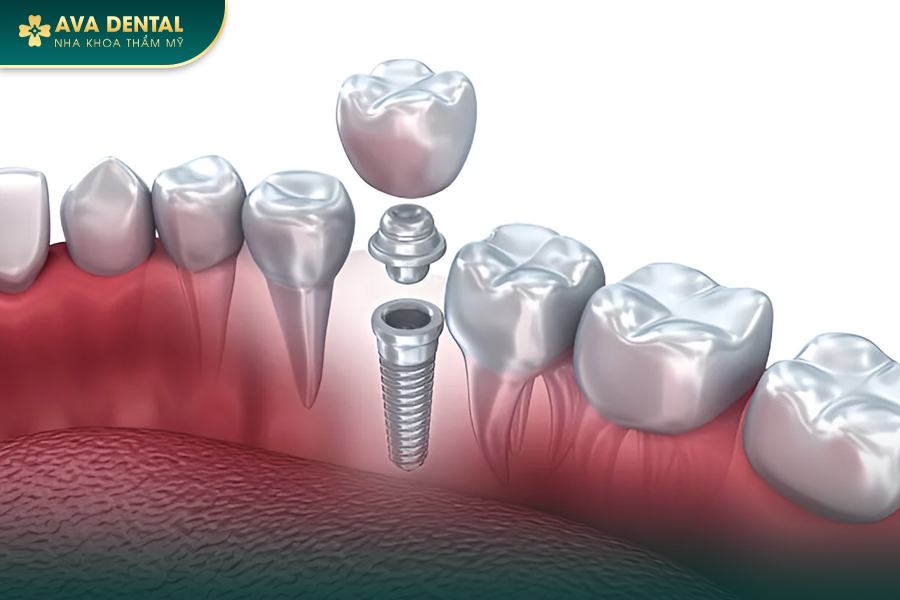 Cấy Ghép Implant Tức Thì Là Gì? Chi Phí Bao Nhiêu 2024? 19 307