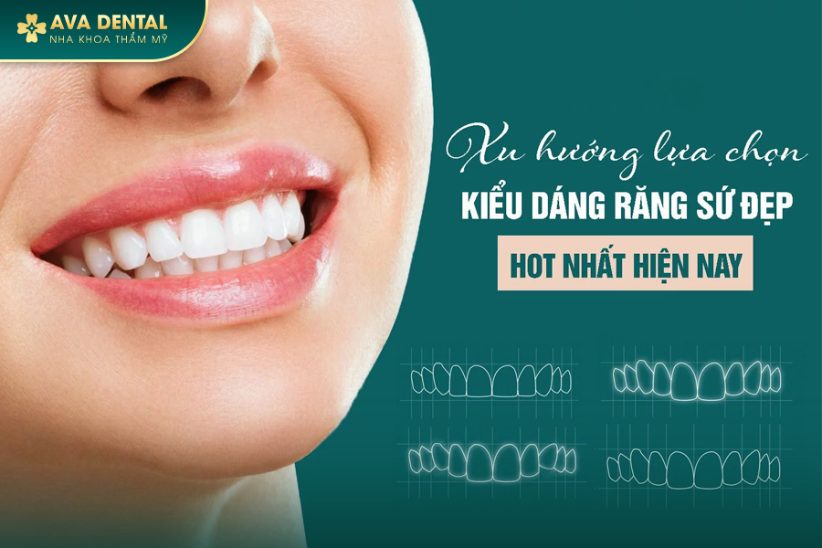 Dán Sứ Veneer Răng Thỏ Là Gì? Chi Phí Bao Nhiêu 2024 20 4 4