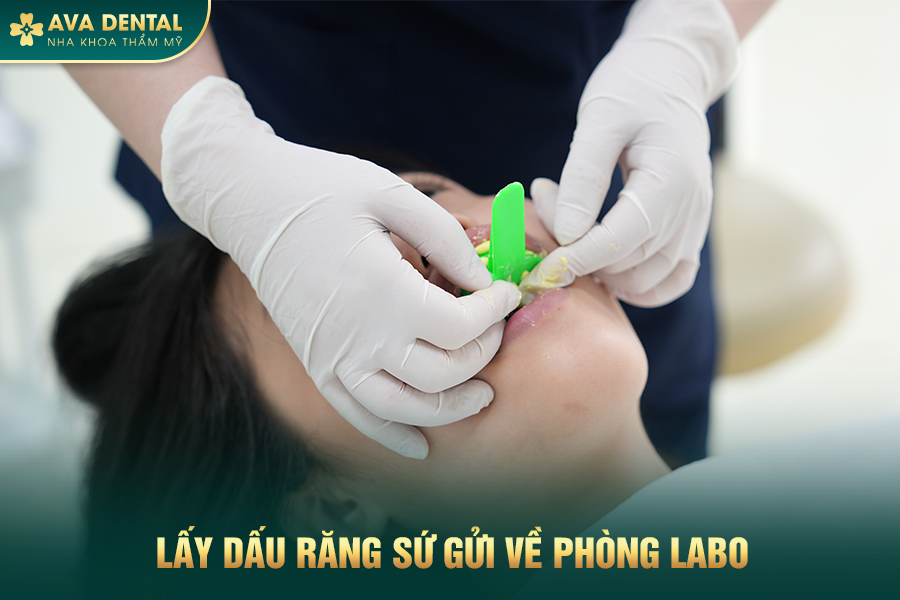 Dán Sứ Veneer Răng Cửa Có Tốt Không? Giá Bao Nhiêu 2024? 29 2 2
