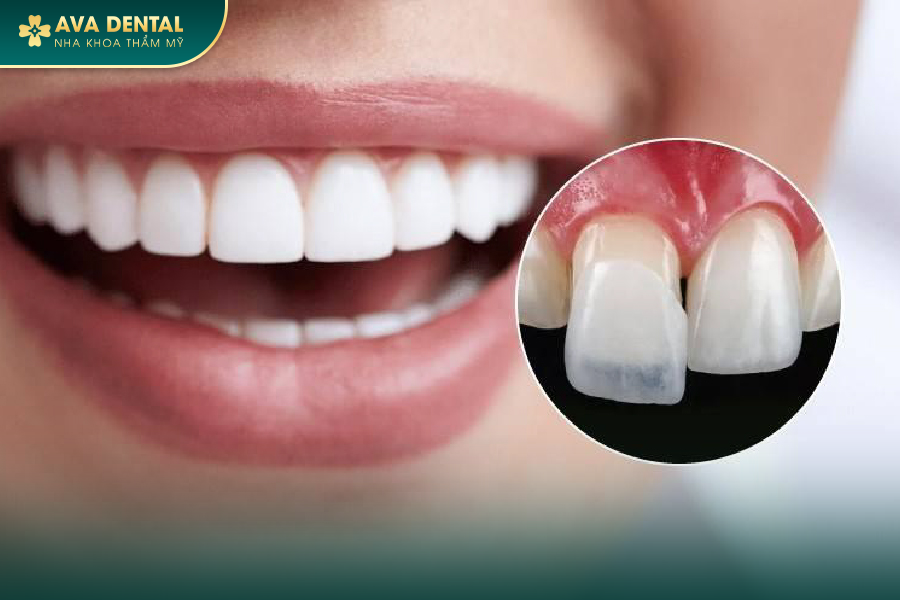 Dán Sứ Veneer Răng Cửa Có Tốt Không? Giá Bao Nhiêu 2024? 22 2 3