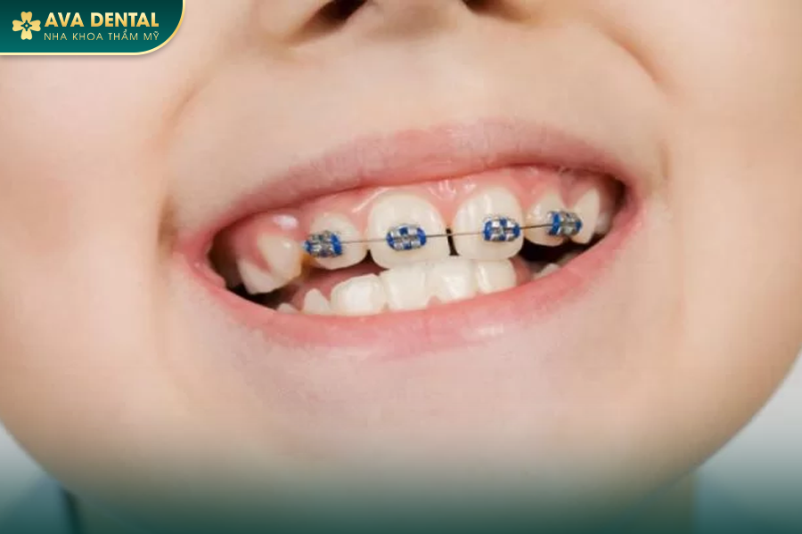 Niềng Răng Là Gì? Độ Tuổi Niềng Răng Bao Nhiêu Là Hợp Lý? 15 1 3