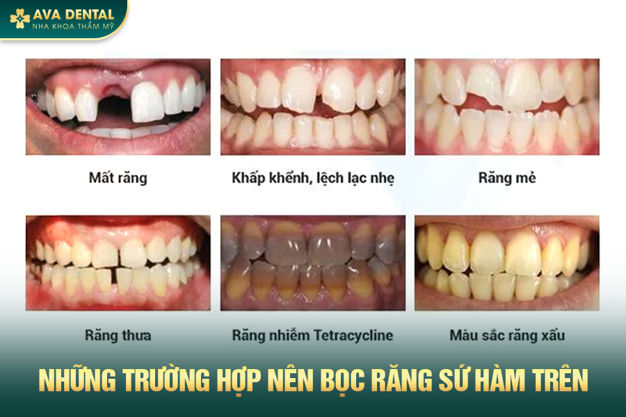 Bọc Răng Sứ Hàm Trên Là Gì? Chi Phí Bao Nhiêu 2024? 14 1