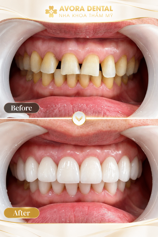 dán sứ veneers
