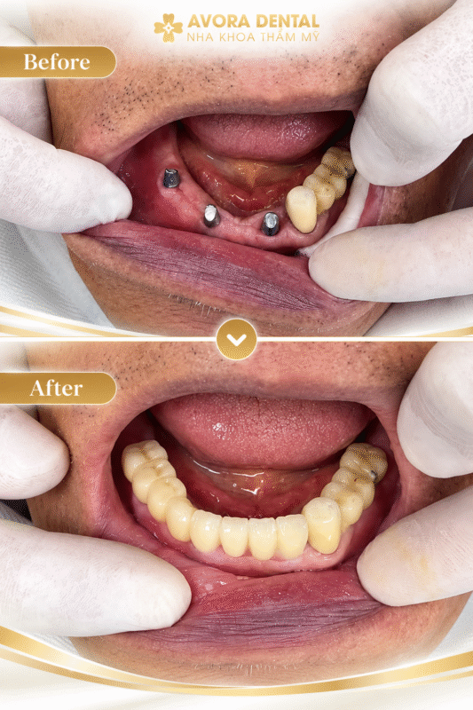 tuổi thọ răng Implant