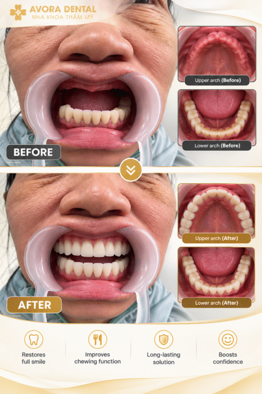 Dental Implant Là Gì? Quy Trình Trồng Răng Implant Và Những Điều Cần Biết 2 dental implants
