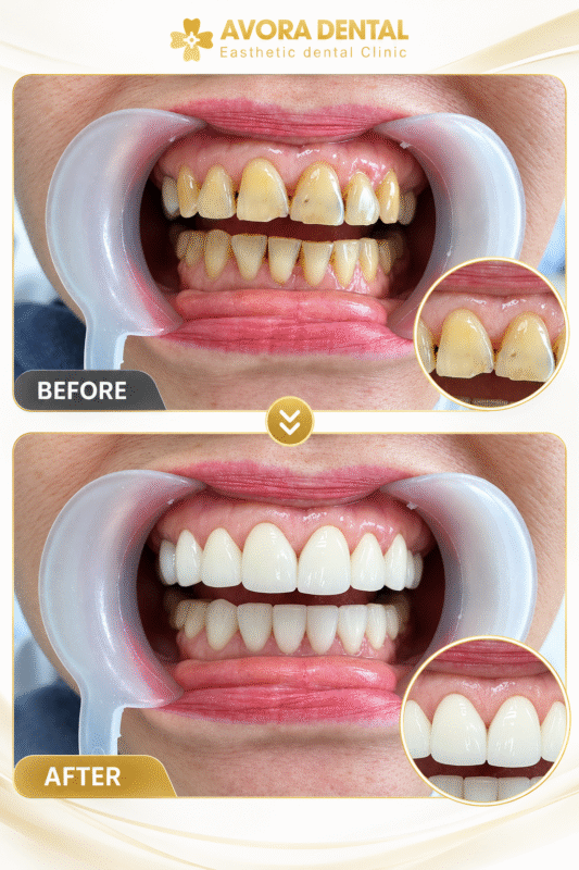 dán sứ Veneers 